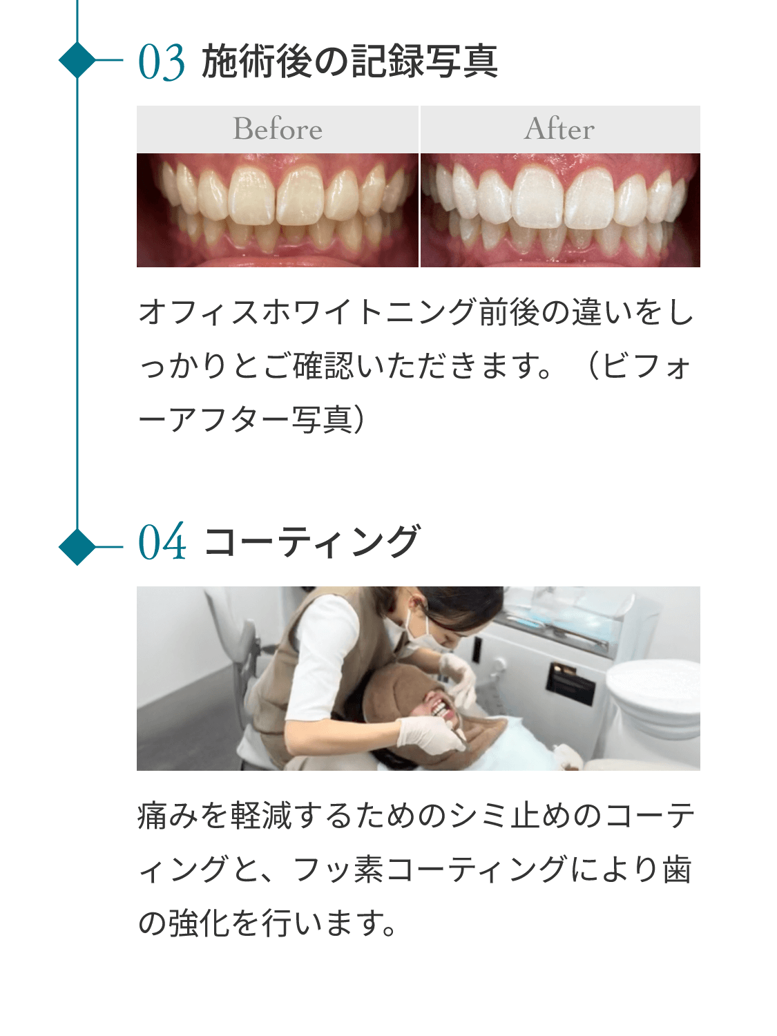 ホワイトニングの流れ